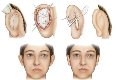 Surgery-Protruding-ears-Tunisia